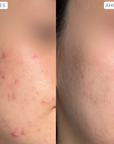 4% Ácido Glicólico + 2.5% Ácido Láctico: Serum Exfoliante (30ml)
